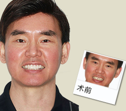全牙缺失